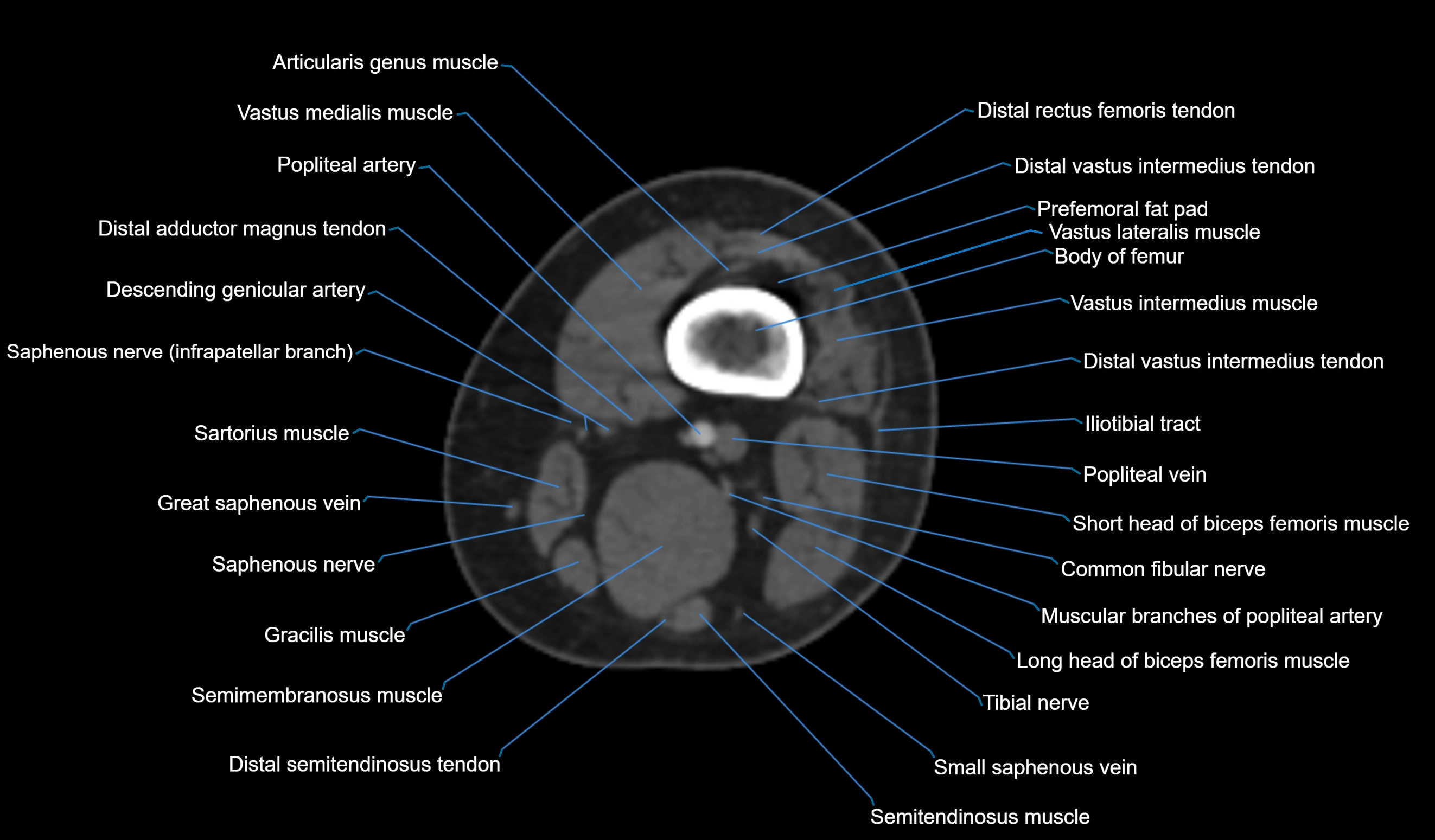CT knee axial cross sectional anatomy labelled image-00007.webp